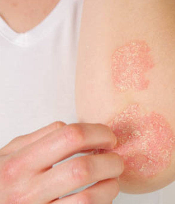Eczema Vs Psoriasis - What's The Difference?